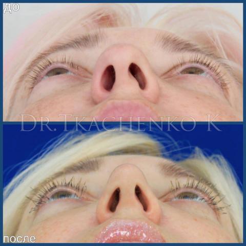 Риносептопластика, Фото до и после операции